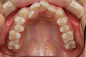 前歯ががたがたし側切歯が口蓋側転位しています